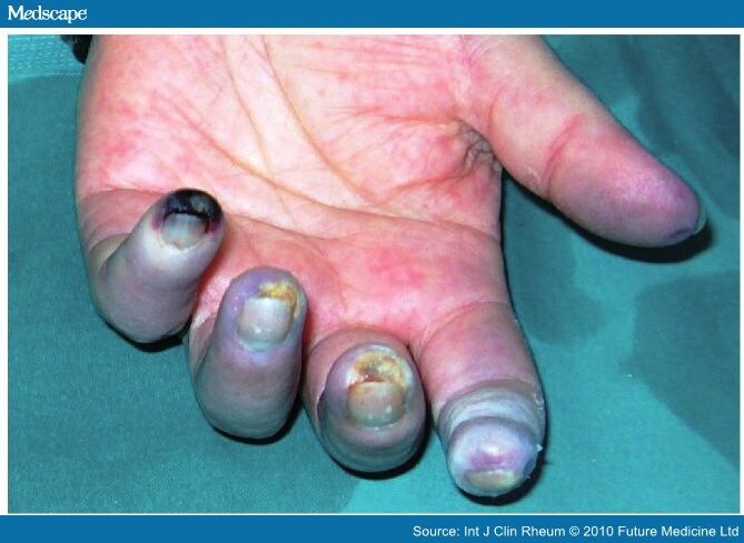 Finger+Ulcers+From+Raynauds Raynaud's And Finger Ulcers http://www.medscape.com/viewarticle/731883 ...