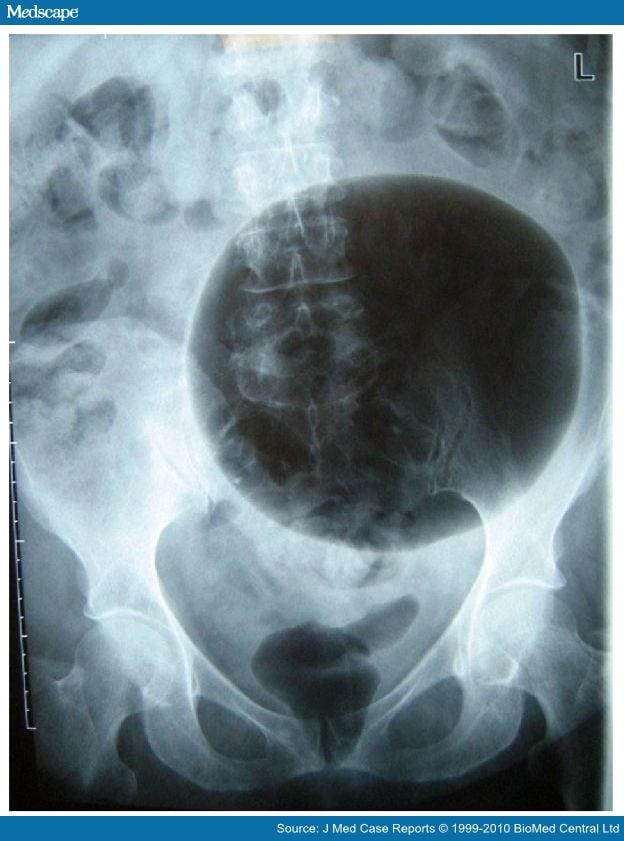 Giant Sigmoid Diverticulum With Metastatic Rectal Carcinomag