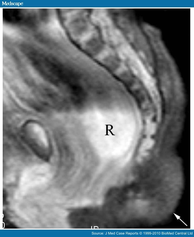 Imperforate Anus With a Rectovestibular Fistula and Pseudotail