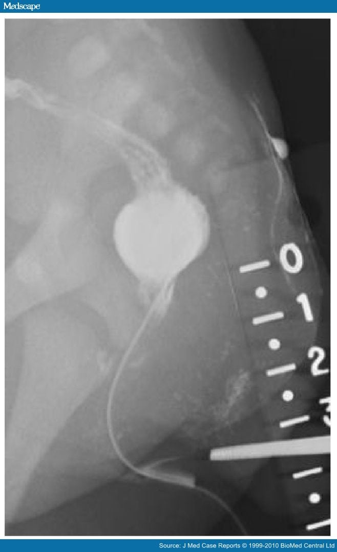 Imperforate Anus With a Rectovestibular Fistula and Pseudotail
