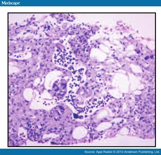 Extramedullary Hematopoiesis Liver