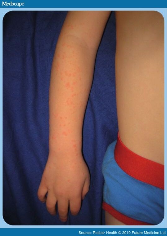 pearly pink papules. Lichenoid monomorphic papules