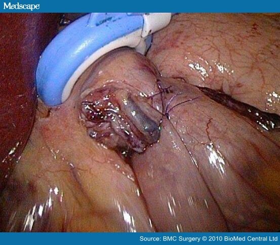 Intra-operative view of the
