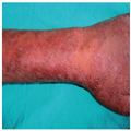 Arthritis in Leprosy: Clinical Features Arthritis in Leprosy: Clinical Features