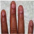 Leprosy Clinical Features | RM. Leprosy Clinical Features | RM.