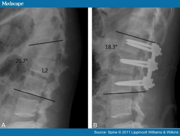 icd 10 l3 compression fracture
