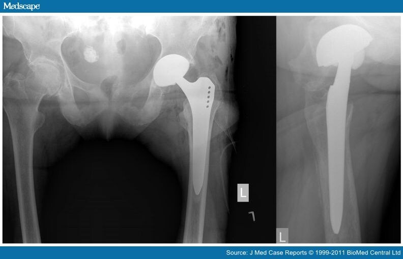 pdf-an-unusual-cause-of-groin-pain-following-hip-replacement-a-case