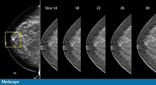 Ge tomosynthesis