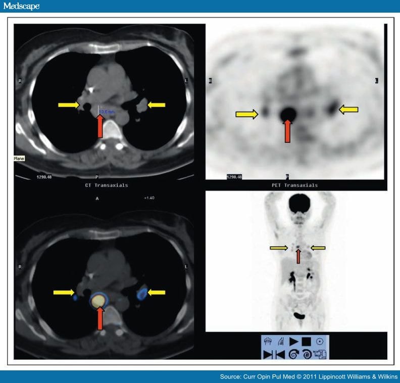Combined Pet And X Ray Ct Imaging In Pulmonary Infections