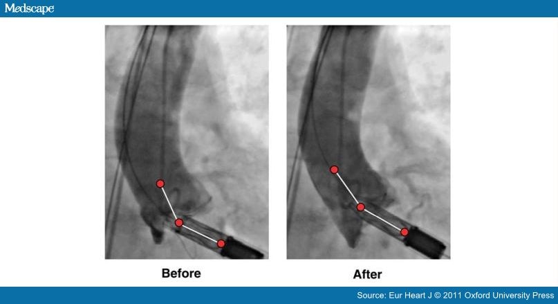 Noncoronary Sinus