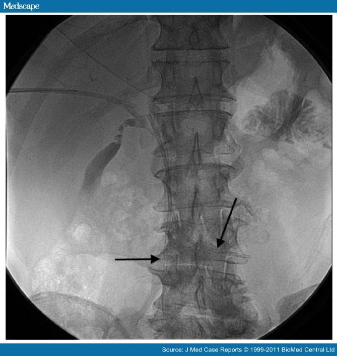 common bile duct anatomy. common bile duct obstruction.