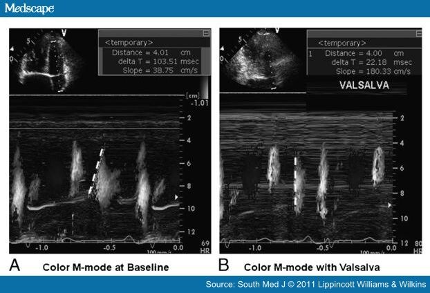 Diastolic Dysfunction Echocardiography. diastolic dysfunction.