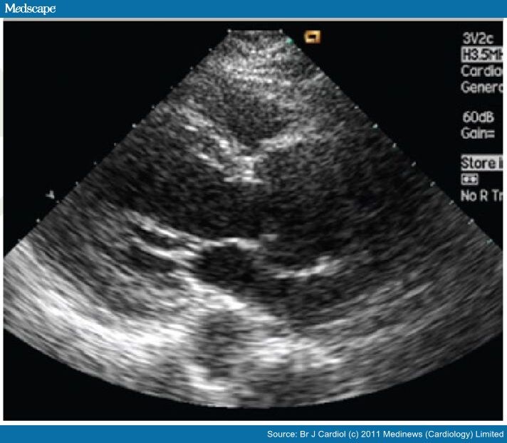 dilated aortic arch dilated aortic arch