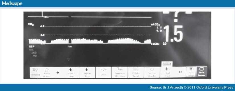 Capnography Traces