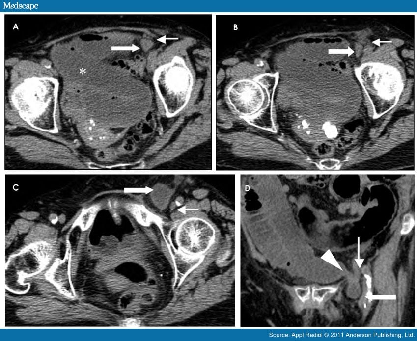 richter hernia ct