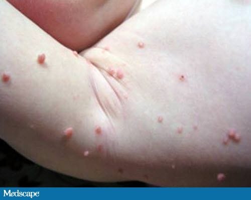 Slideshow: Lumps and Bumps: What’s on My Skin? - WebMD