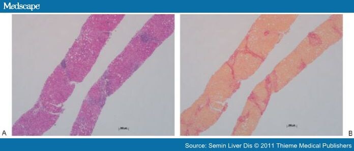 transjugular liver biopsy