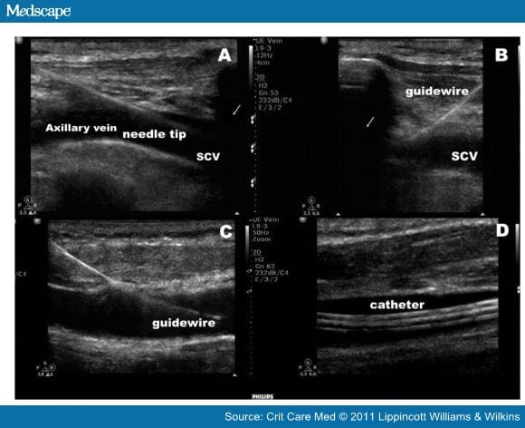 Ultrasound-Guided Subclavian Vein Cannulation Vs Landmark