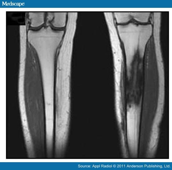 Chronic Osteomyelitis of the Tibia With a Brodie's Abscess