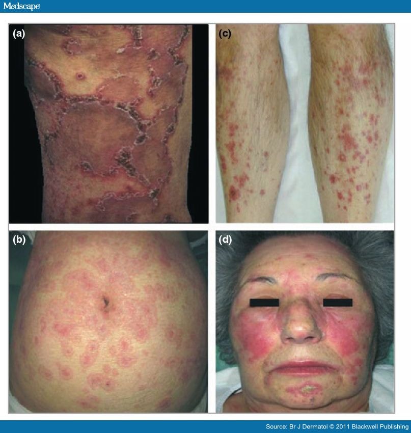 vasculitic rash