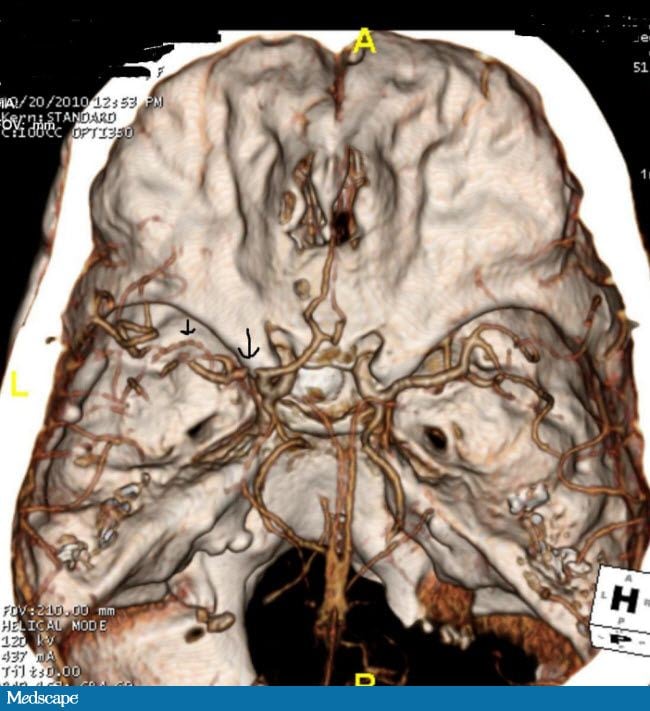 Image result for cns vasculitis