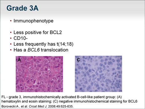 Follicular Lymphoma: Evaluating First-Line Treatment Options (Transcript)