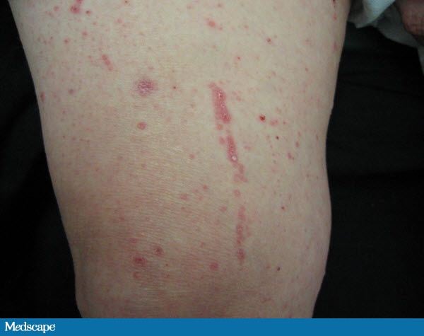 A 48 Year Old Woman With An Itchy Rash