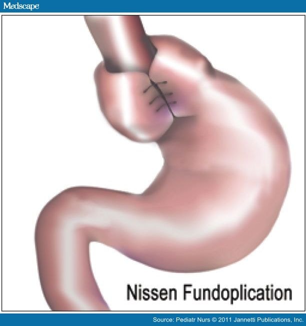 Nissan fundoplication post-op pain #2