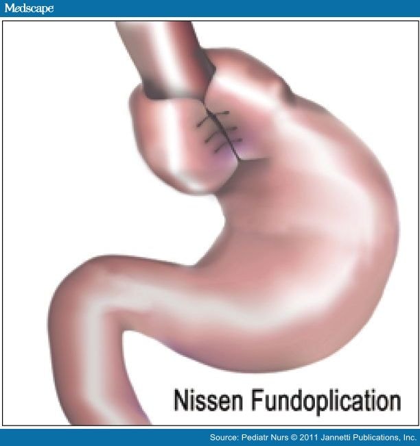 Nissan surgical procedure