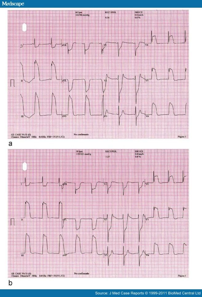 R Wave Ekg