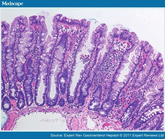 fragments of tubular adenoma and hyperplastic polyp