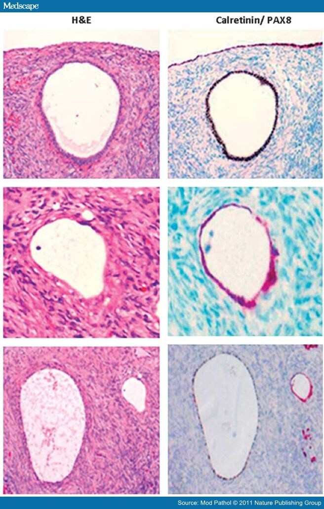 Tubal Origin Of Ovarian Low Grade Serous Carcinoma