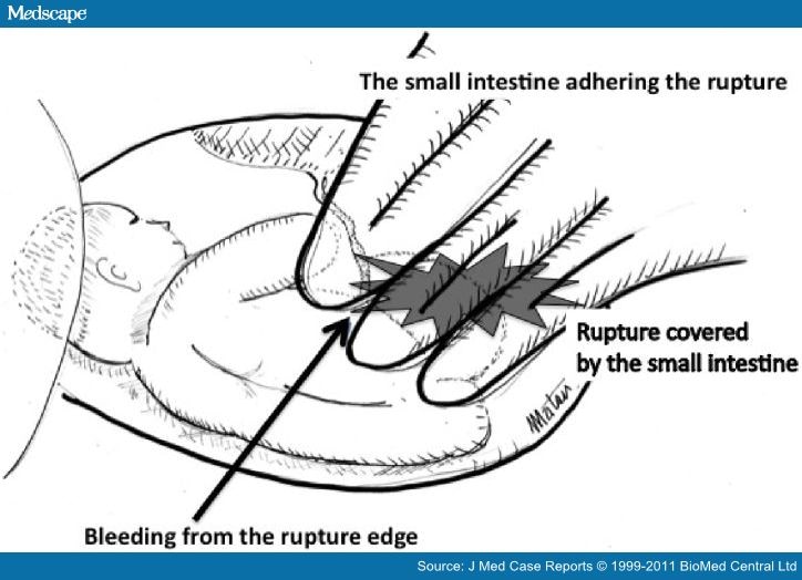 ruptured  small intestine