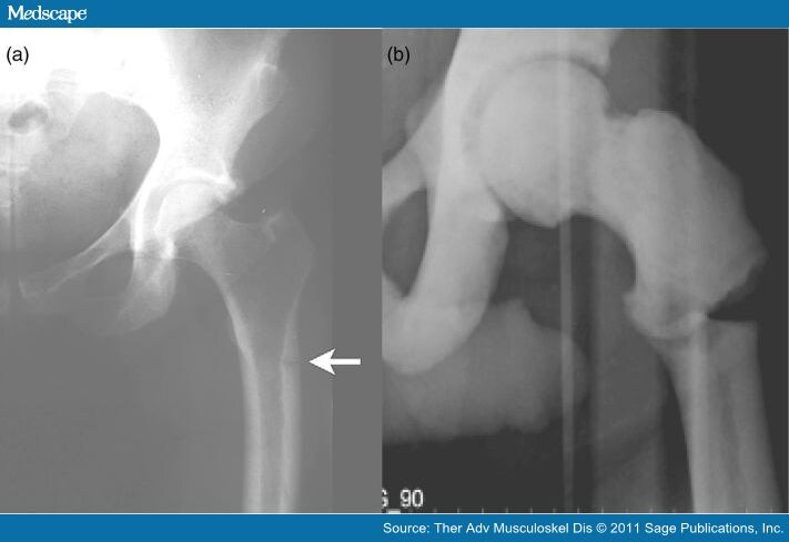 atypical fractures