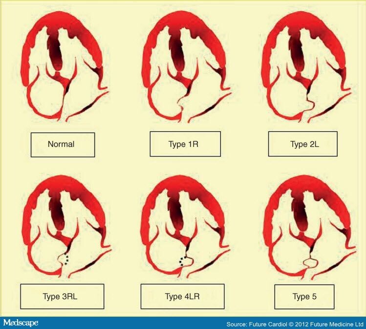 Aneurysmal Interatrial Septum