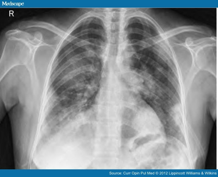 Varicella pneumonia adults
