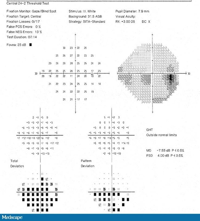 Acute Painless Monocular Vision Loss
