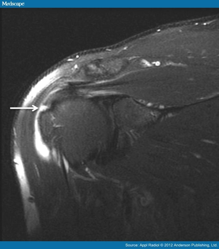 MRI of the Shoulder: Rotator Cuff