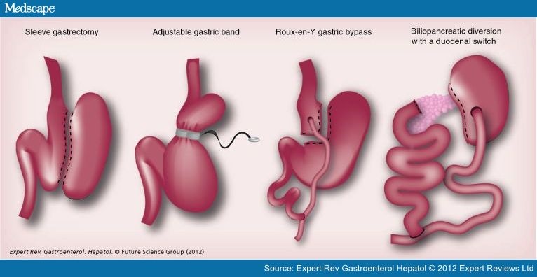 Fatty Liver Disease And Bariatric Surgery