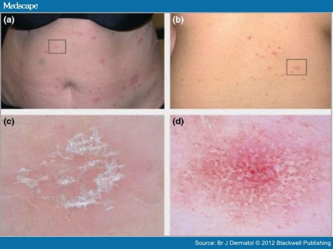 lichen planus histology #11