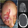 frontal sinus obliteration