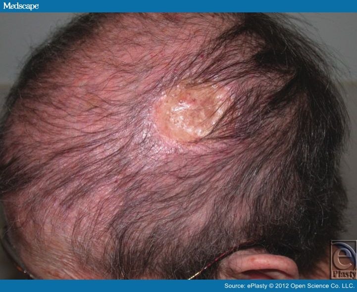 Scalp Reconstruction And Acellular Dermal Matrix, Skin Graft