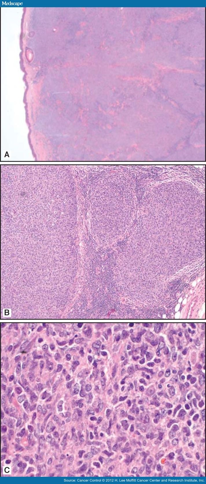 Primary Cutaneous B-Cell Lymphomas