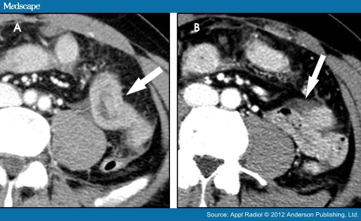 Bowel Contusion Perforation