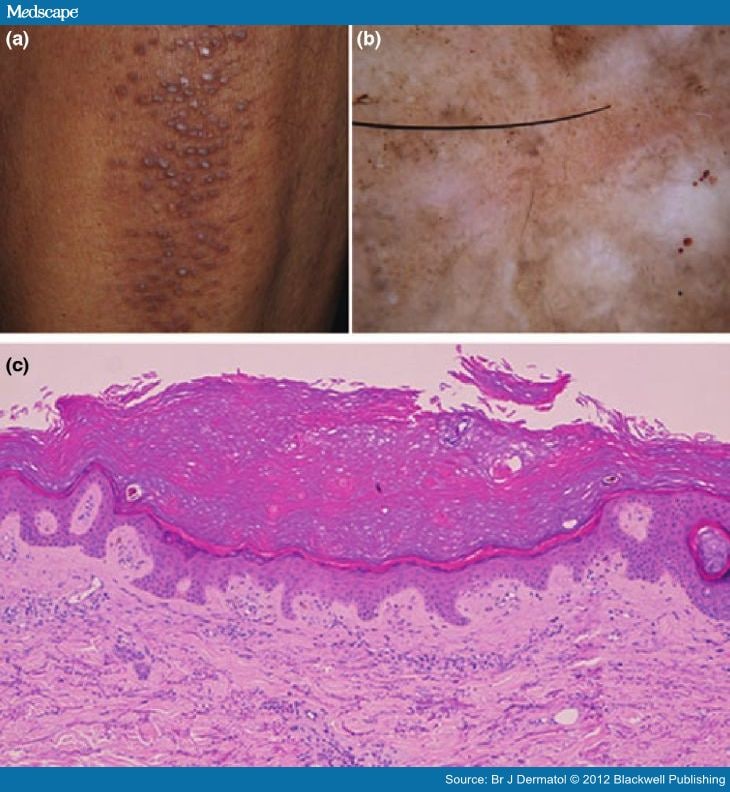 Dermoscopic Features Of Primary Cutaneous Amyloidosis