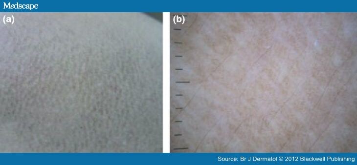 Dermoscopic Features Of Primary Cutaneous Amyloidosis 9203