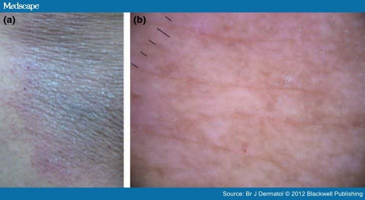 Dermoscopic Features Of Primary Cutaneous Amyloidosis 3652