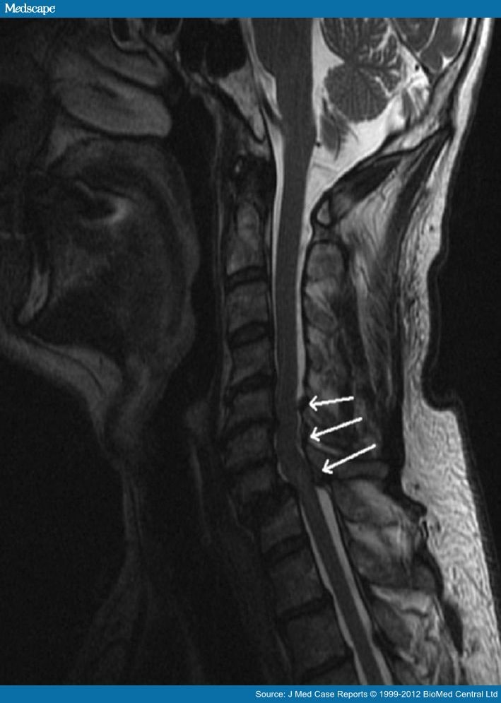 Retrolisthesis lumbar spine Retrolisthesis lumbar spine image