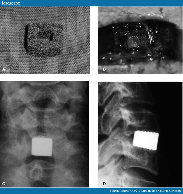 Cost Effectiveness of Cervical Fusion With Tantalum Implant