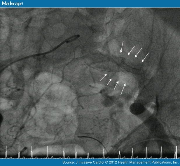 Treatment Of Coronary Aneurysms With Covered Stents